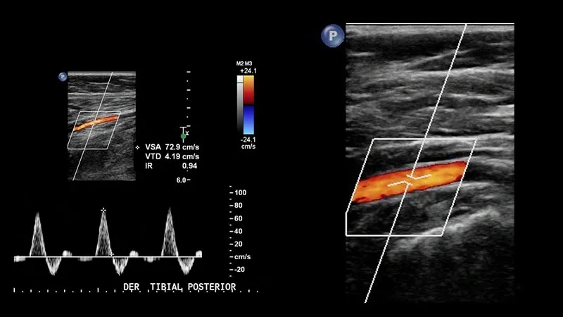 Doppler Arterial de Miembros